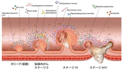 がんの進行（多段階発がん）と腸内環境の変動?。ポリープ（腺腫）から粘膜内がん、比較的早期のがん、進行がんへと進むにつれて、増殖する細菌や代謝産物はダイナミックに変動する（提供・大阪大学と国立がん研究センターの研究グループ）