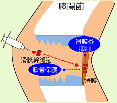 滑膜幹細胞注射による治療の模式図 (東京医科歯科大学提供)