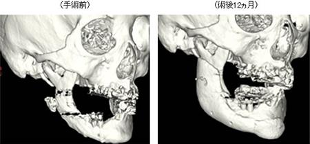 カスタムメイド人工骨による骨欠損の治療