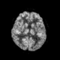 開放型PET装置で得られた脳の断層画像