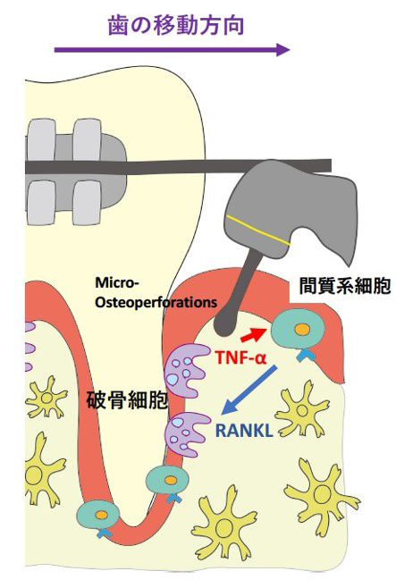 TNFアルファが間質系細胞に働き、RANKL（ランクル）が出ることで間接的に破骨細胞が作られ、歯の移動が促されている（東北大学提供）