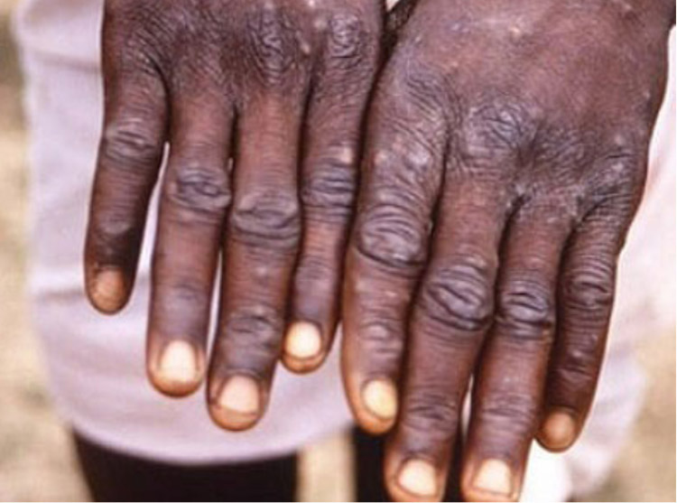 手に現れたサル痘の特有の症状（WHO提供）