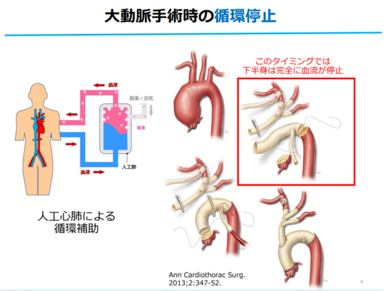 現在、大動脈手術時に行われている循環停止（図右）と人工心肺による循環補助（図左）の模式図。将来、人工冬眠技術が応用できれば臓器損傷リスクは低下すると期待されている（理研・京都大学提供）