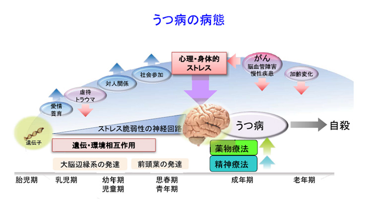AIが脳画像を解析してうつ病診断 広島大など、客観的検査に道