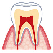 歯の構造。一番外側がエナメル質、内側のベージュ色が象牙質。根っこの最外層がセメント質