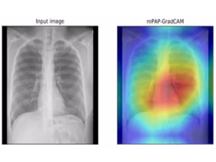 心不全患者の予後、AIが胸部X線画像から予測 徳島大など