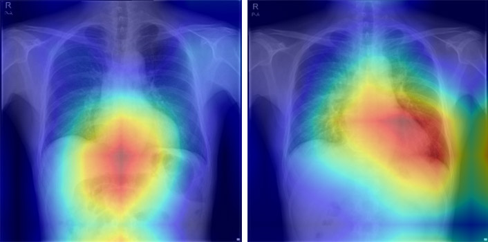 AIが心不全確率0.6％と判断した胸部X線画像（左）と、心不全確率99.3％と判断した画像。判断理由を示すようにAIが注目領域を色づけしている（徳島大学病院の楠瀬賢也講師提供）