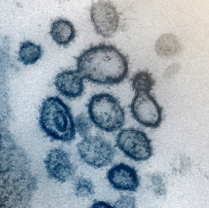 初期の新型コロナウイルスの電子顕微鏡画像（米国立アレルギー・感染症研究所提供）