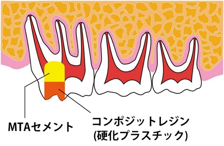 今回の動物実験の模式図。人間の歯の治療で採用されている方法をラットに用いた（大倉直人助教提供）