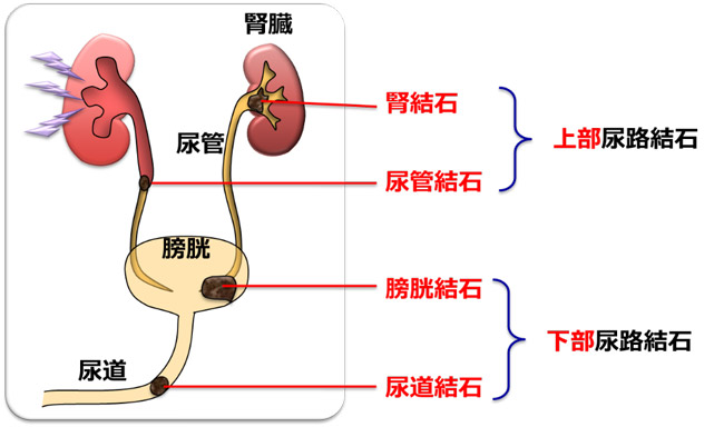 尿路結石は腎臓や尿管、膀胱、尿道にできた結石。日本においては食生活の欧米化にともなって増加し、現在では国民の約10％がかかる病気となっている（名古屋市立大学の岡田淳志准教授提供）