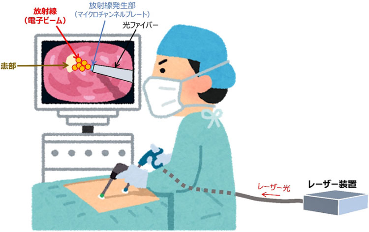 内視鏡を用いたがん放射線治療をするイメージ（量研機構提供）