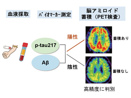 アルツハイマー病、原因タンパクの血液検査で発症予測 東大など、早期診断に期待