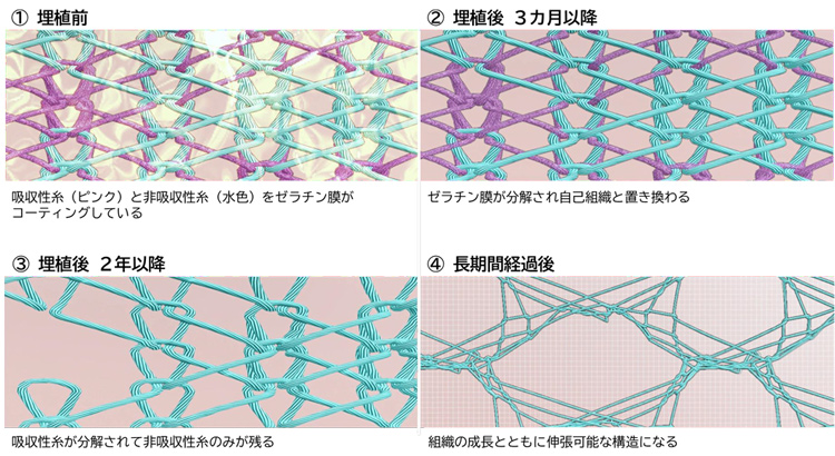 パッチが生体になじむ様子を図版にしたもの。あやとりのように美しい形で、吸収性糸と非吸収性糸がうまく絡み合ってできている(帝人提供)