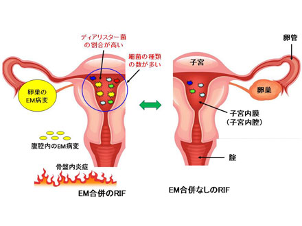 反復着床不全で子宮内膜症の患者、歯周病菌を子宮内から高頻度に検出 山梨大など