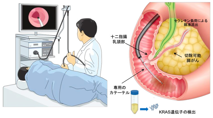 胃がん検診時に膵(すい)臓がんを早期発見する方法のイメージ図(大阪大学提供)