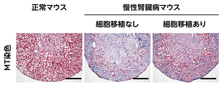 実験マウスの腎臓。中央のiPS細胞由来腎前駆細胞の「細胞移植なし」のマウスの腎臓組織は線維化が進んでいる。「細胞移植あり」は正常マウスに近い腎臓組織になっていることが分かる(京都大学iPS細胞研究所提供)