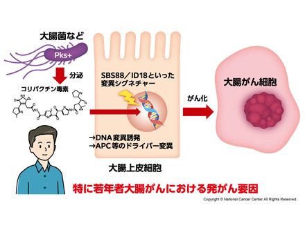 大腸がん、5割は腸内細菌関与の可能性 分泌毒素で固有のゲノム変異 国立がん研など