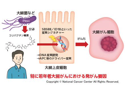 大腸がん、5割は腸内細菌関与の可能性 分泌毒素で固有のゲノム変異 国立がん研など