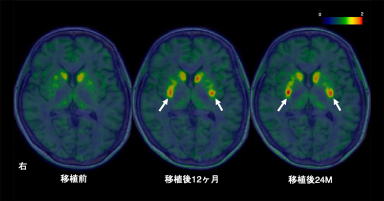 iPS細胞由来の細胞を脳内に移植して24カ月間観察したところ、ドーパミン神経の活動が増加していた(矢印が示す赤い部分、CiRA提供)